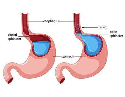 A diagrammatic representation of stomach acid and contents returning to the esophagus, causing acid reflux or GERD