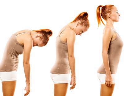 Three poses of a woman in a tank top highlight her scoliosis, demonstrating her body alignment