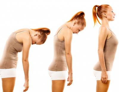 Three poses of a woman in a tank top highlight her scoliosis, demonstrating her body alignment