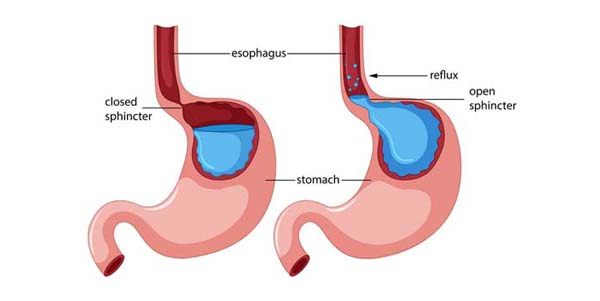 A diagrammatic representation of stomach acid and contents returning to the esophagus, causing acid reflux or GERD