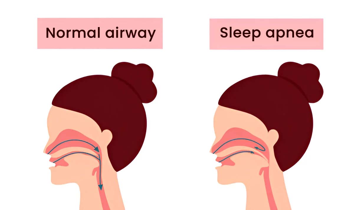 A diagram representing the process of normal breathing and sleep apnea