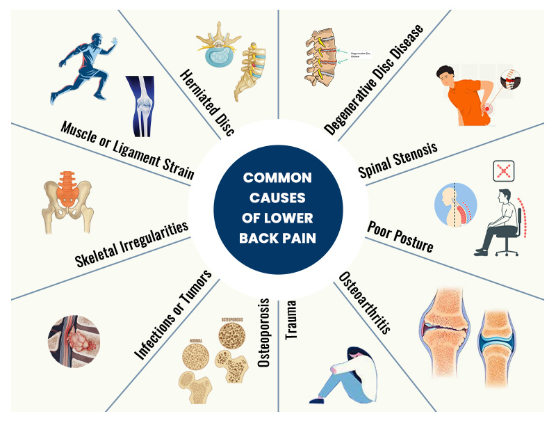 A pictorial representation of the common causes of lower back pain