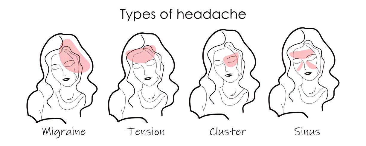 Graphical explanation of the types of headaches