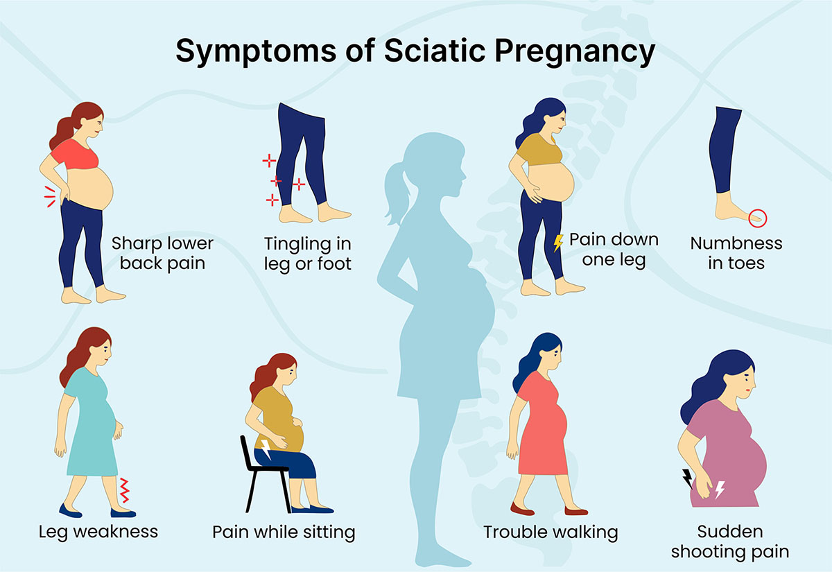 Symptoms of sciatica during pregnancy, illustrated vividly.